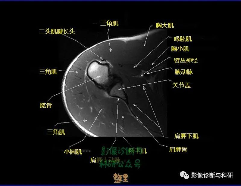 影像PPT - 肩关节MR轴位详细标注-14