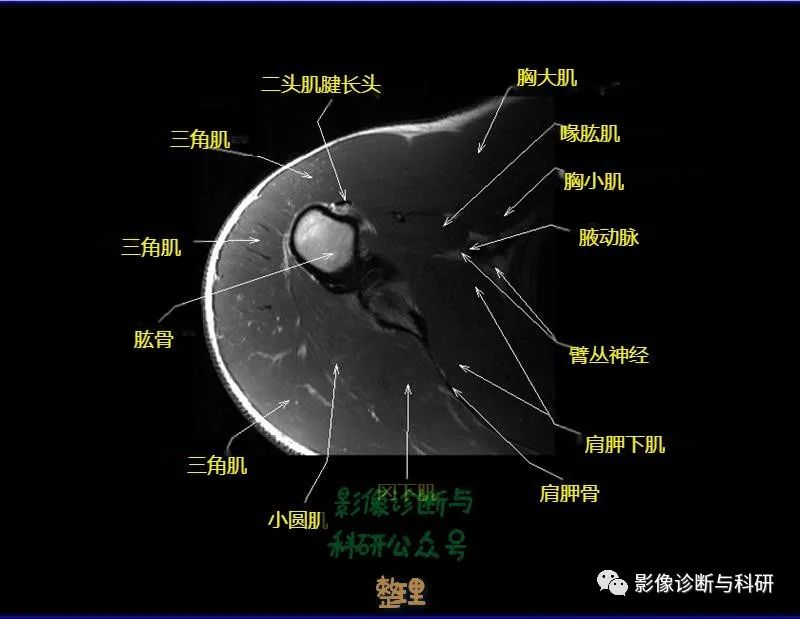 影像PPT - 肩关节MR轴位详细标注-15