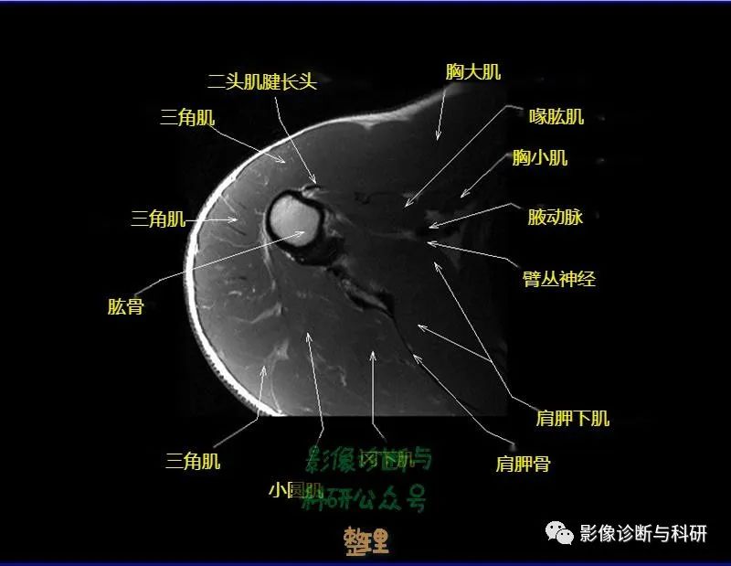 影像PPT - 肩关节MR轴位详细标注-16