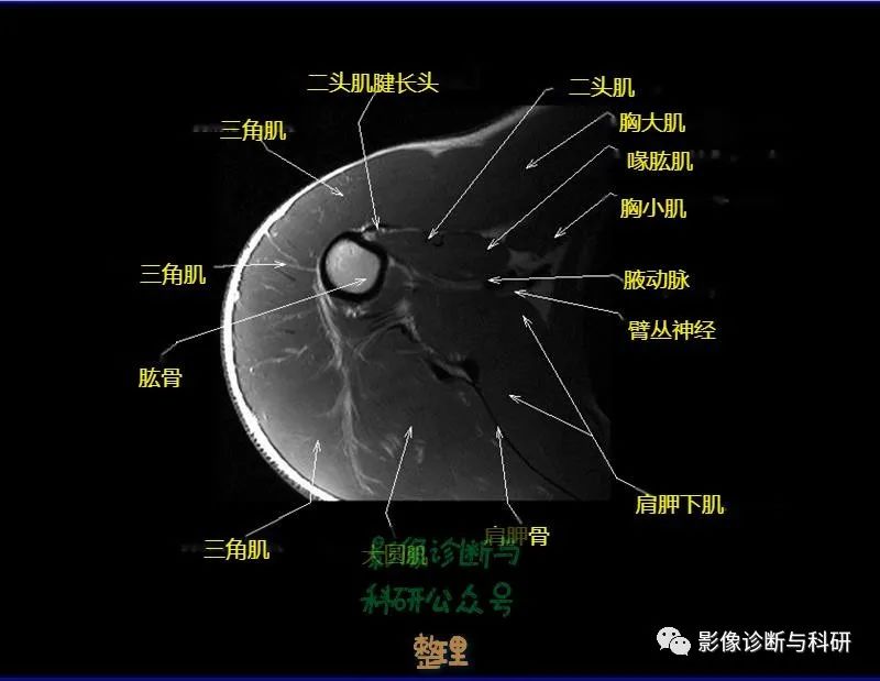 影像PPT - 肩关节MR轴位详细标注-17