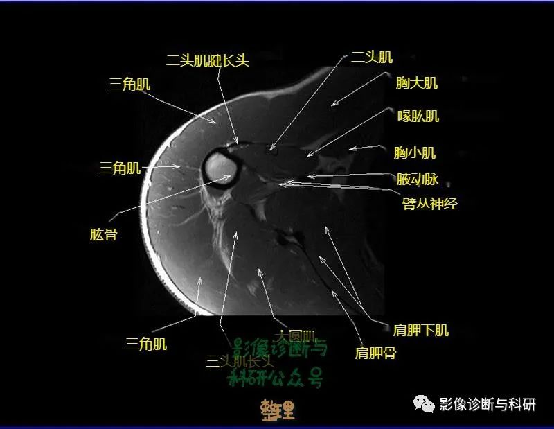 影像PPT - 肩关节MR轴位详细标注-18