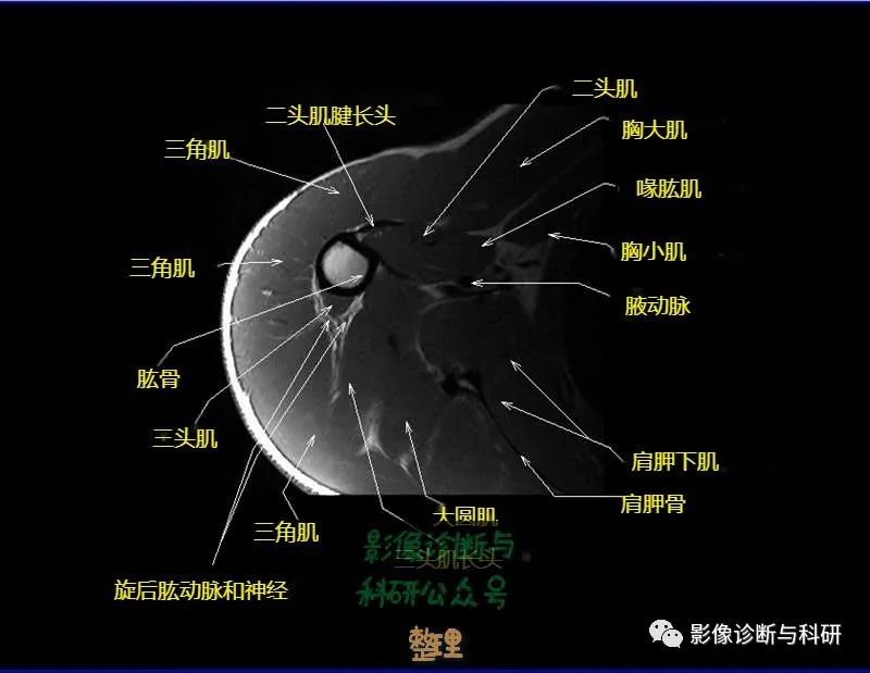 影像PPT - 肩关节MR轴位详细标注-19