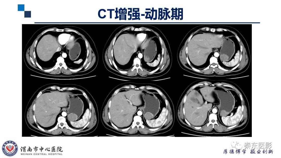 影像PPT - 【病例】胃肠道间质瘤-4