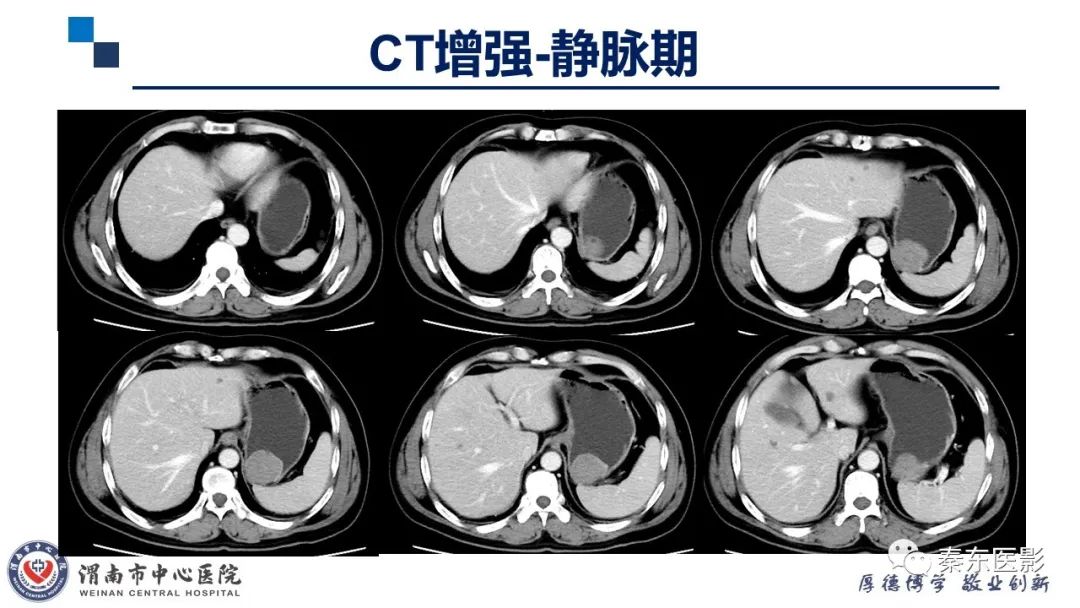 影像PPT - 【病例】胃肠道间质瘤-5