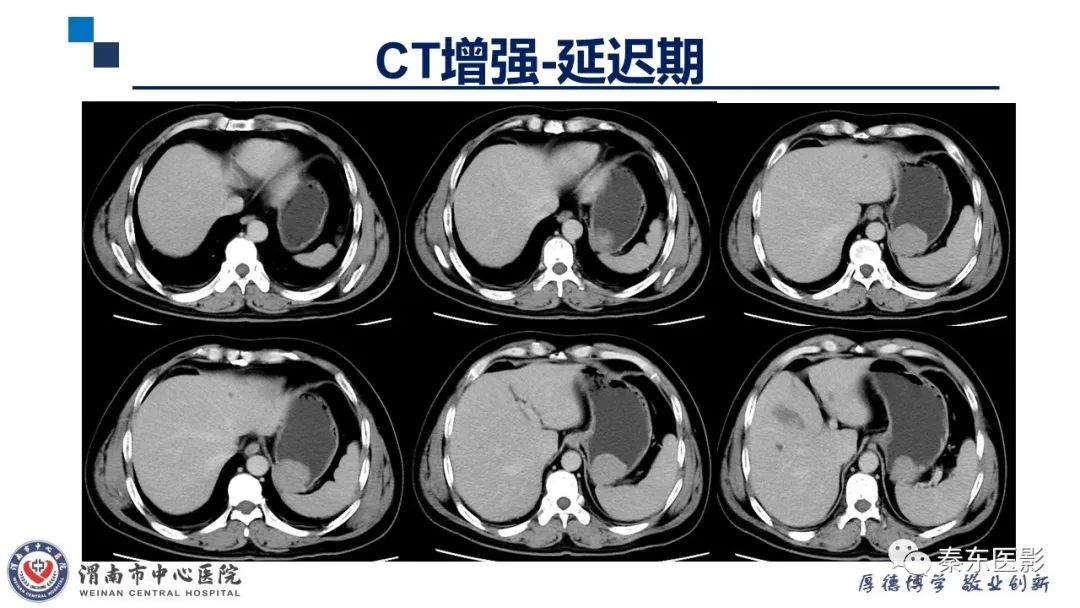 影像PPT - 【病例】胃肠道间质瘤-6