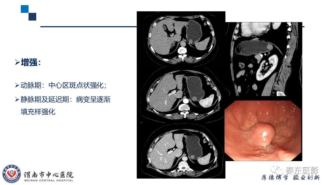 影像PPT - 【病例】胃肠道间质瘤-15