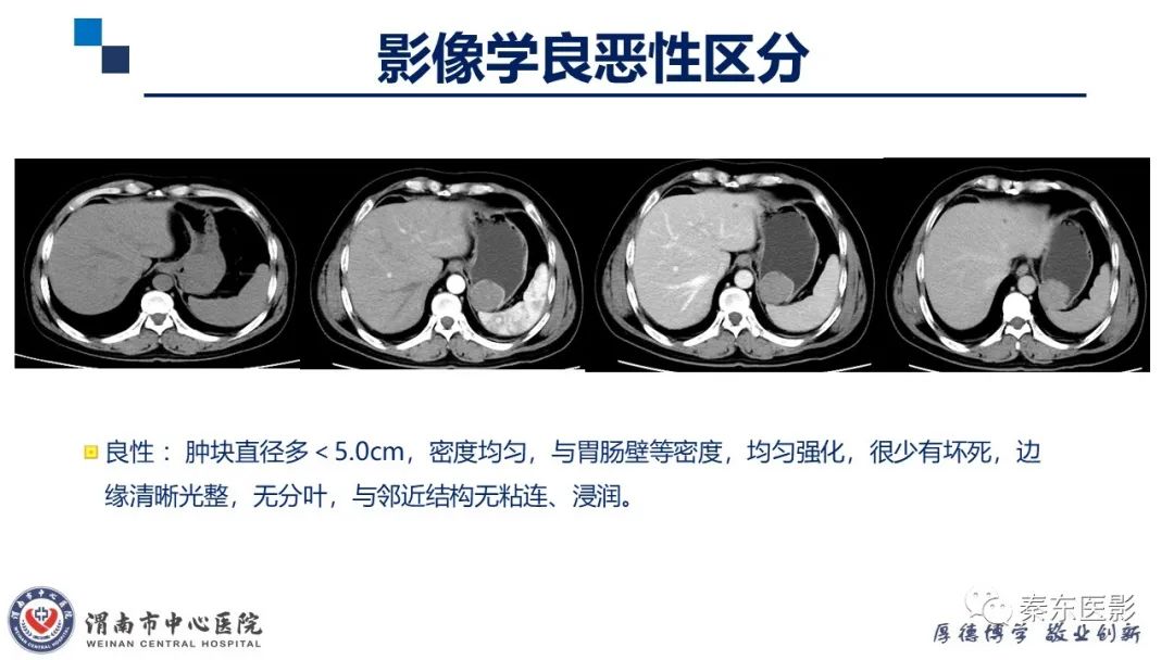 影像PPT - 【病例】胃肠道间质瘤-16