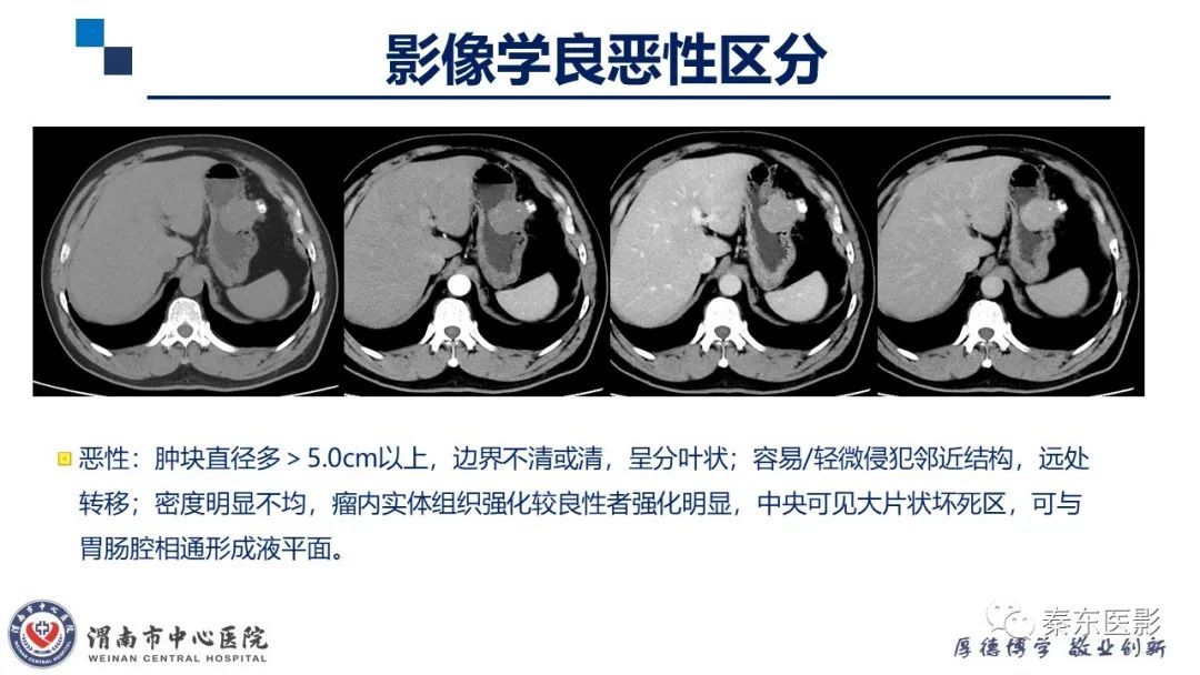 影像PPT - 【病例】胃肠道间质瘤-17
