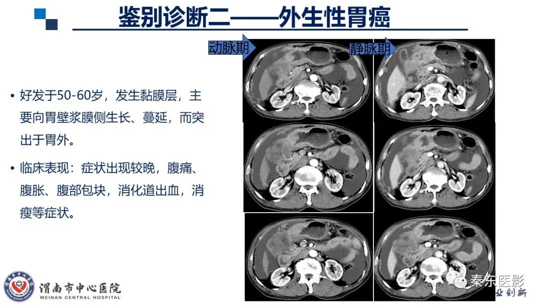 影像PPT - 【病例】胃肠道间质瘤-19