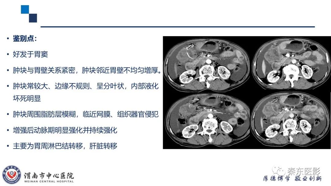 影像PPT - 【病例】胃肠道间质瘤-20