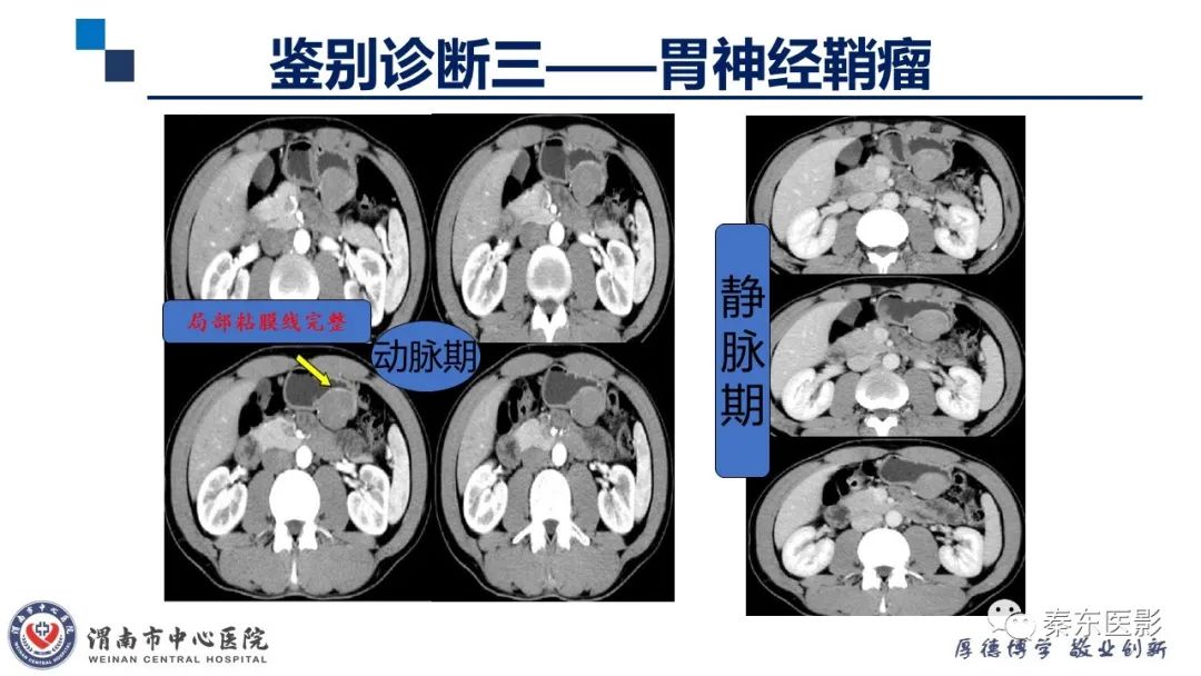 影像PPT - 【病例】胃肠道间质瘤-22