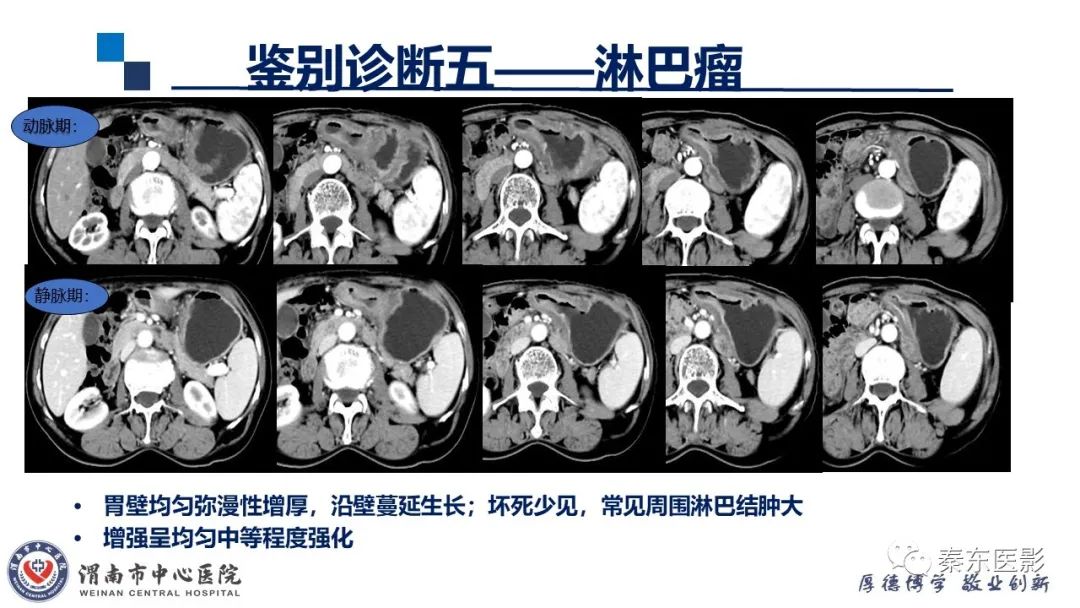 影像PPT - 【病例】胃肠道间质瘤-24