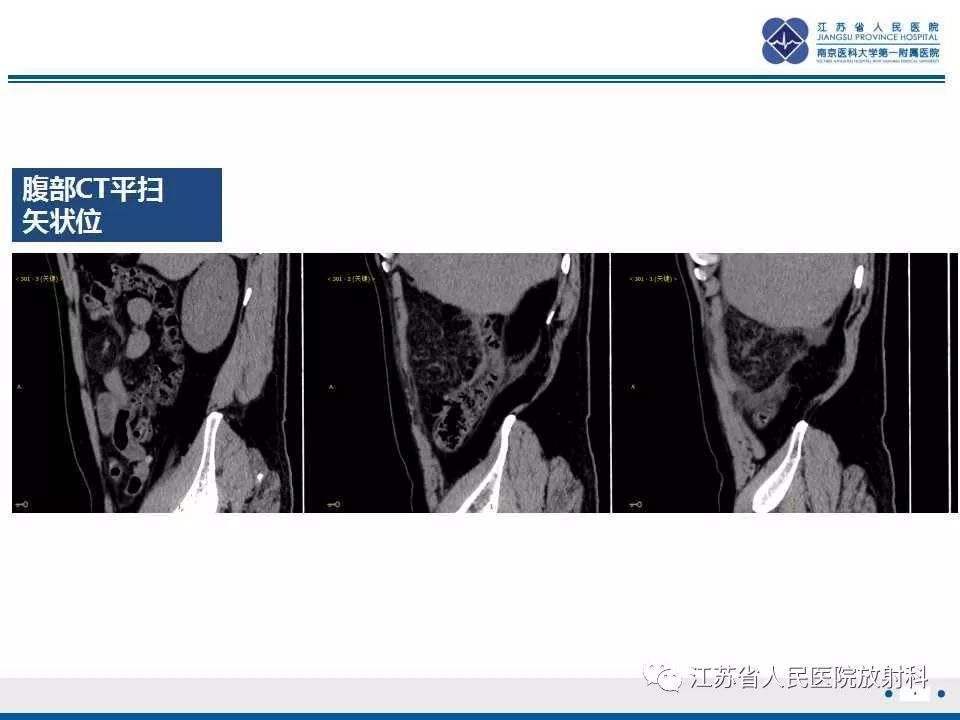 影像PPT - 【PPT】网膜梗死-5