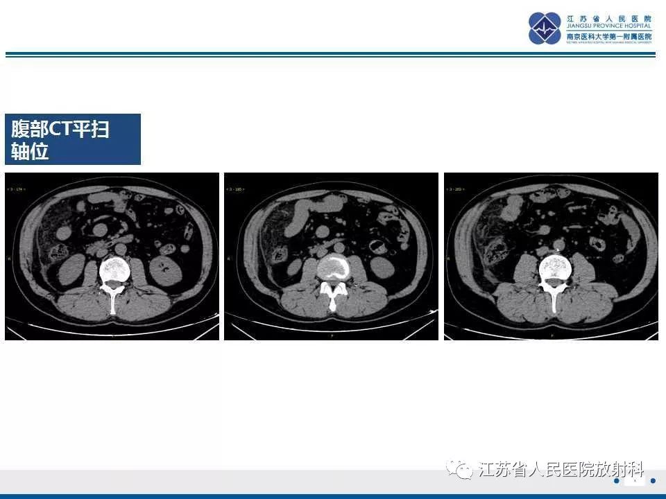 影像PPT - 【PPT】网膜梗死-4
