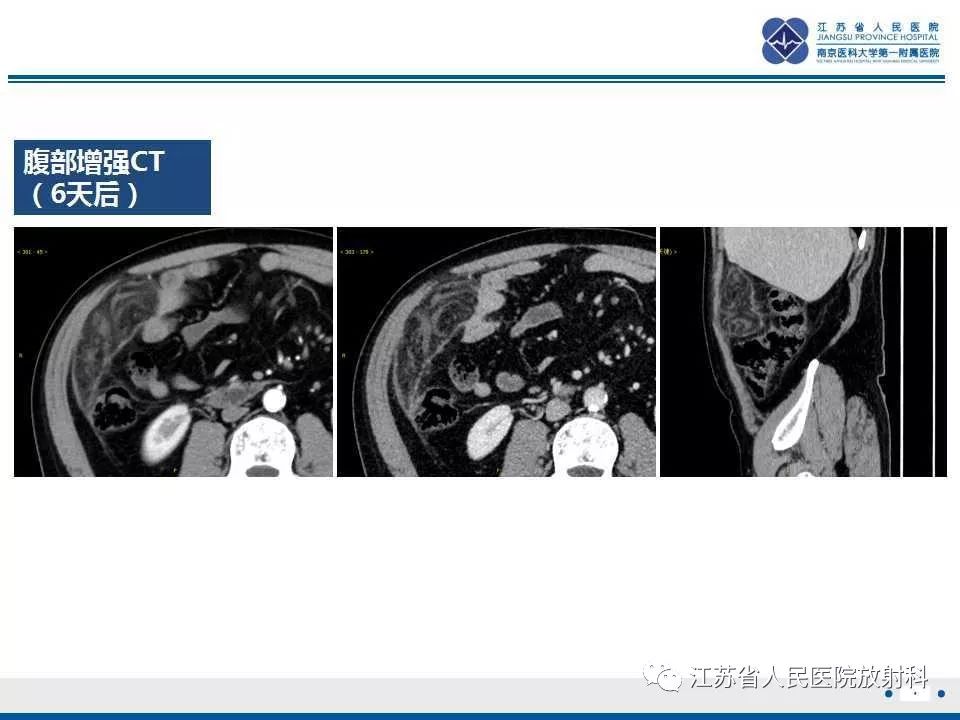 影像PPT - 【PPT】网膜梗死-6