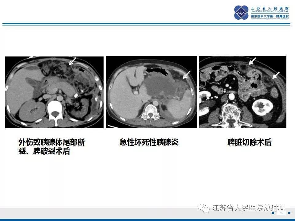 影像PPT - 【PPT】网膜梗死-20