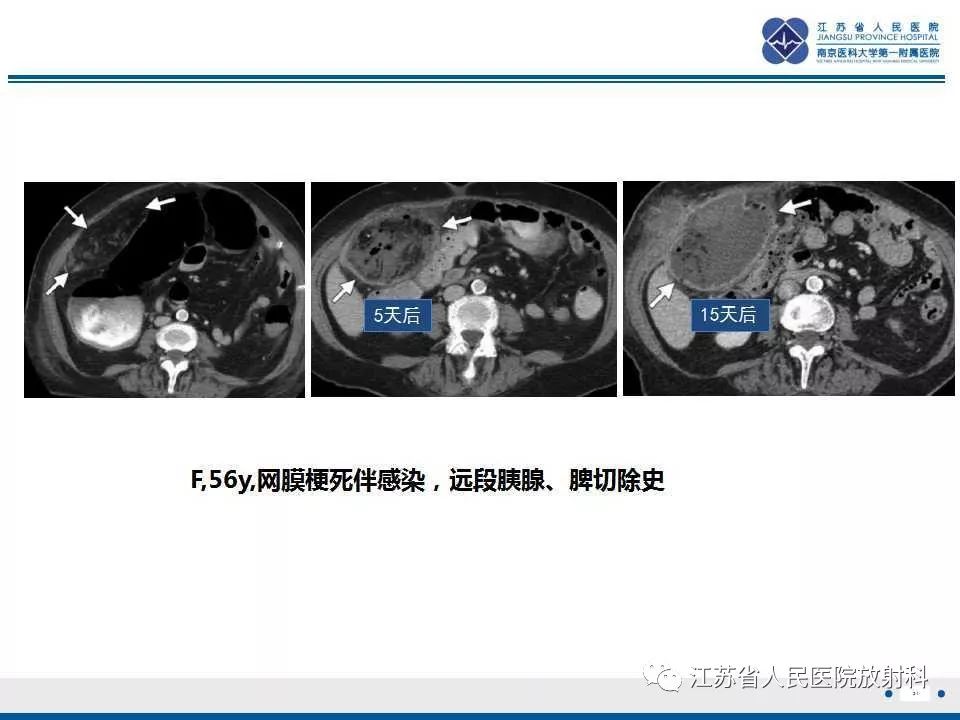 影像PPT - 【PPT】网膜梗死-21