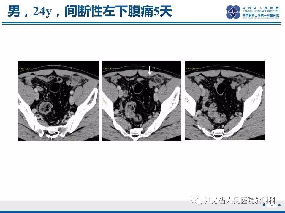 影像PPT - 【PPT】网膜梗死-26