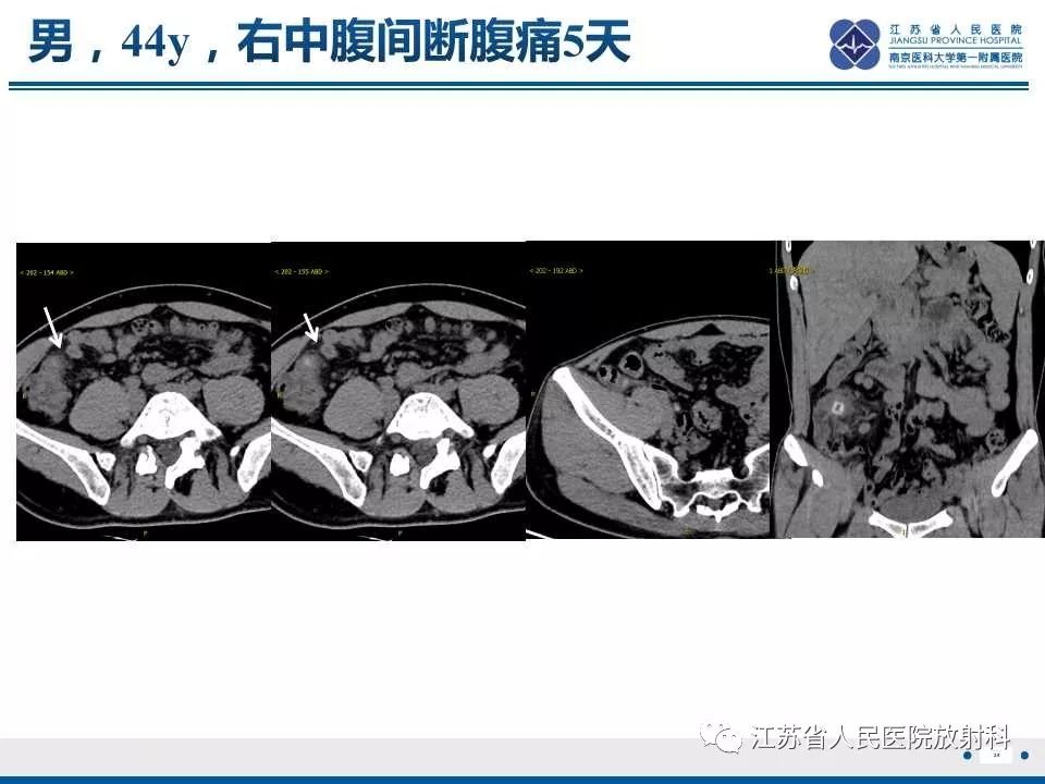 影像PPT - 【PPT】网膜梗死-28