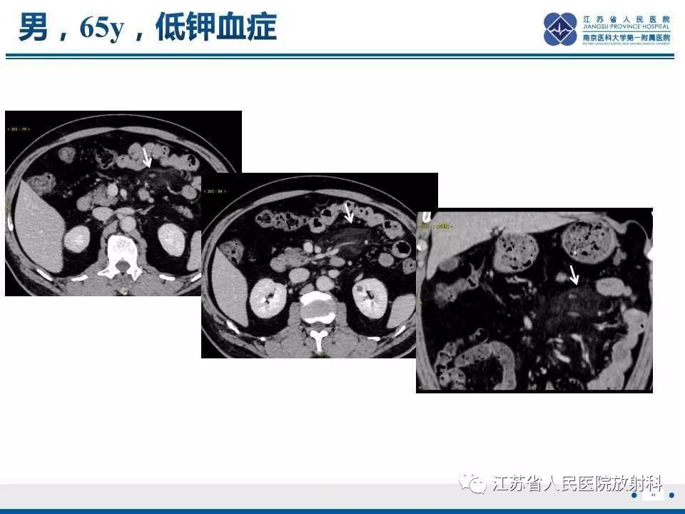 影像PPT - 【PPT】网膜梗死-30