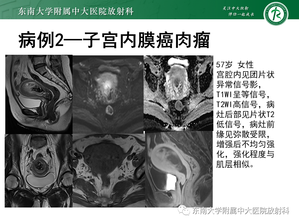 影像PPT - 【PPT】子宫内膜癌MRI诊断-5 影像PPT - 【PPT】子宫内膜癌MRI诊断-5
