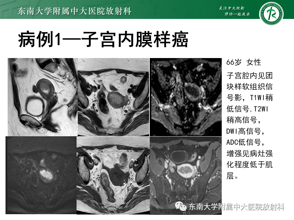 影像PPT - 【PPT】子宫内膜癌MRI诊断-3 影像PPT - 【PPT】子宫内膜癌MRI诊断-3