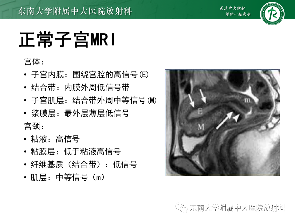 影像PPT - 【PPT】子宫内膜癌MRI诊断-13 影像PPT - 【PPT】子宫内膜癌MRI诊断-13