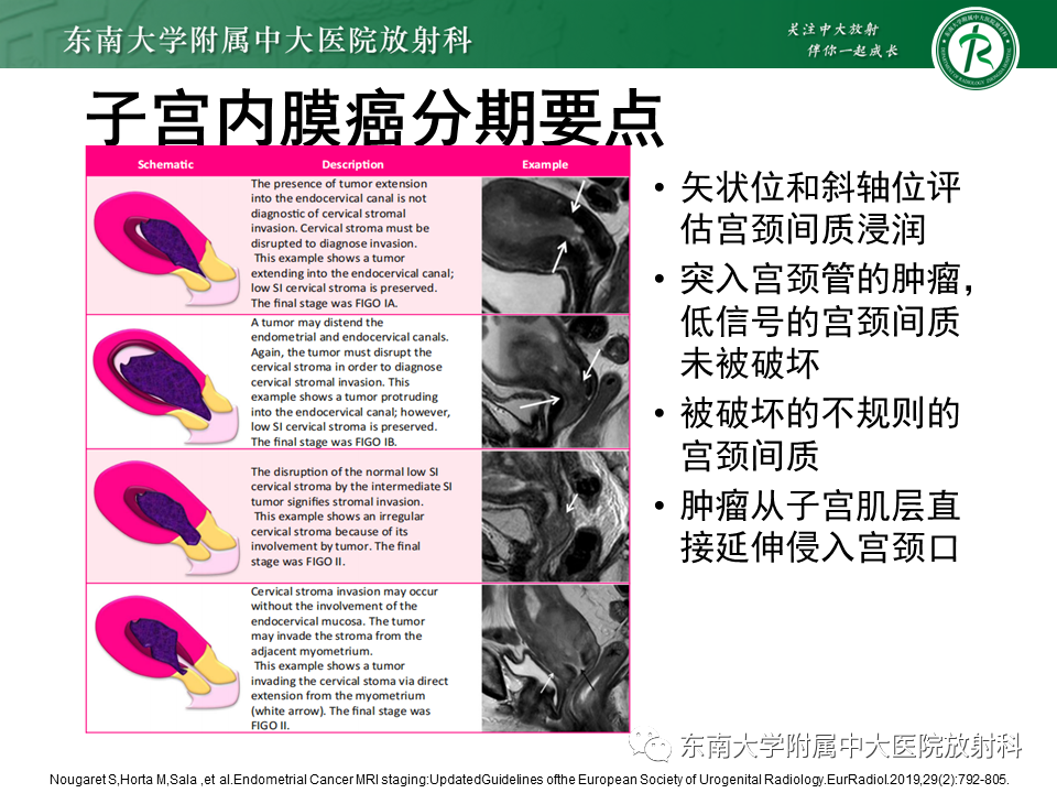影像PPT - 【PPT】子宫内膜癌MRI诊断-18 影像PPT - 【PPT】子宫内膜癌MRI诊断-18