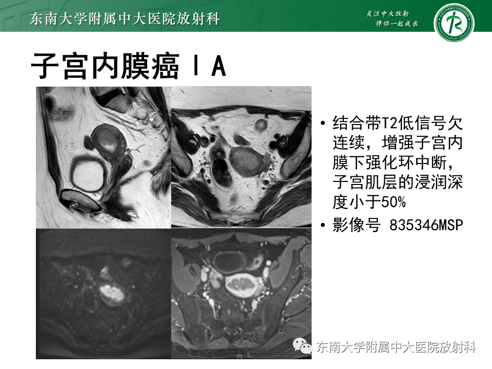 影像PPT - 【PPT】子宫内膜癌MRI诊断-19 影像PPT - 【PPT】子宫内膜癌MRI诊断-19