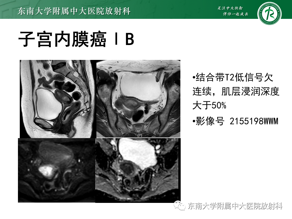 影像PPT - 【PPT】子宫内膜癌MRI诊断-20 影像PPT - 【PPT】子宫内膜癌MRI诊断-20