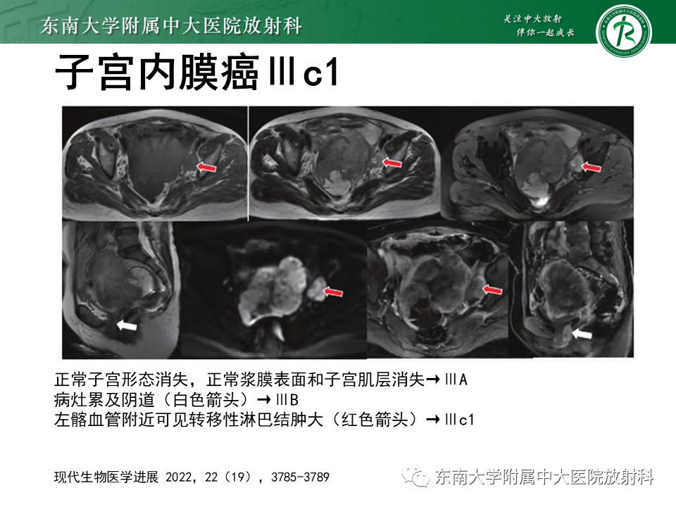 影像PPT - 【PPT】子宫内膜癌MRI诊断-22 影像PPT - 【PPT】子宫内膜癌MRI诊断-22