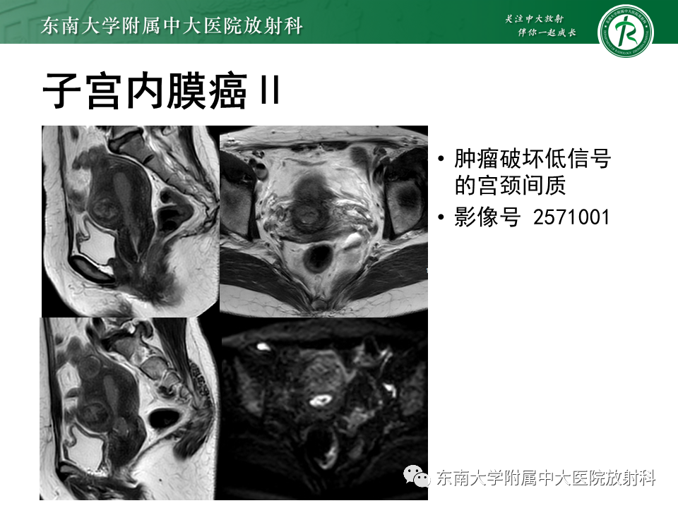 影像PPT - 【PPT】子宫内膜癌MRI诊断-21 影像PPT - 【PPT】子宫内膜癌MRI诊断-21