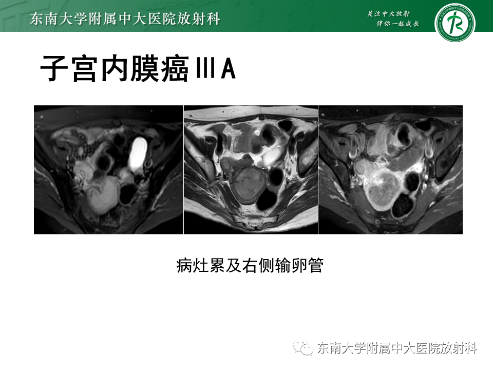 影像PPT - 【PPT】子宫内膜癌MRI诊断-23 影像PPT - 【PPT】子宫内膜癌MRI诊断-23