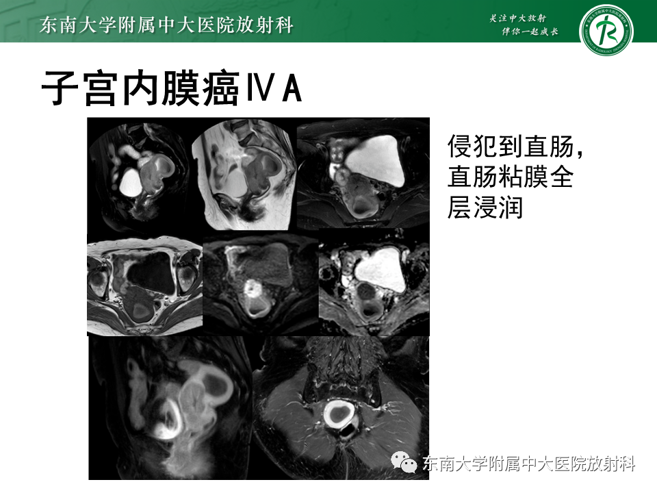 影像PPT - 【PPT】子宫内膜癌MRI诊断-24 影像PPT - 【PPT】子宫内膜癌MRI诊断-24