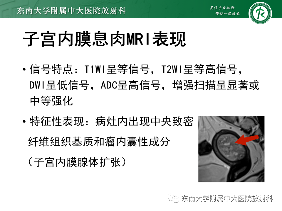 影像PPT - 【PPT】子宫内膜癌MRI诊断-30 影像PPT - 【PPT】子宫内膜癌MRI诊断-30