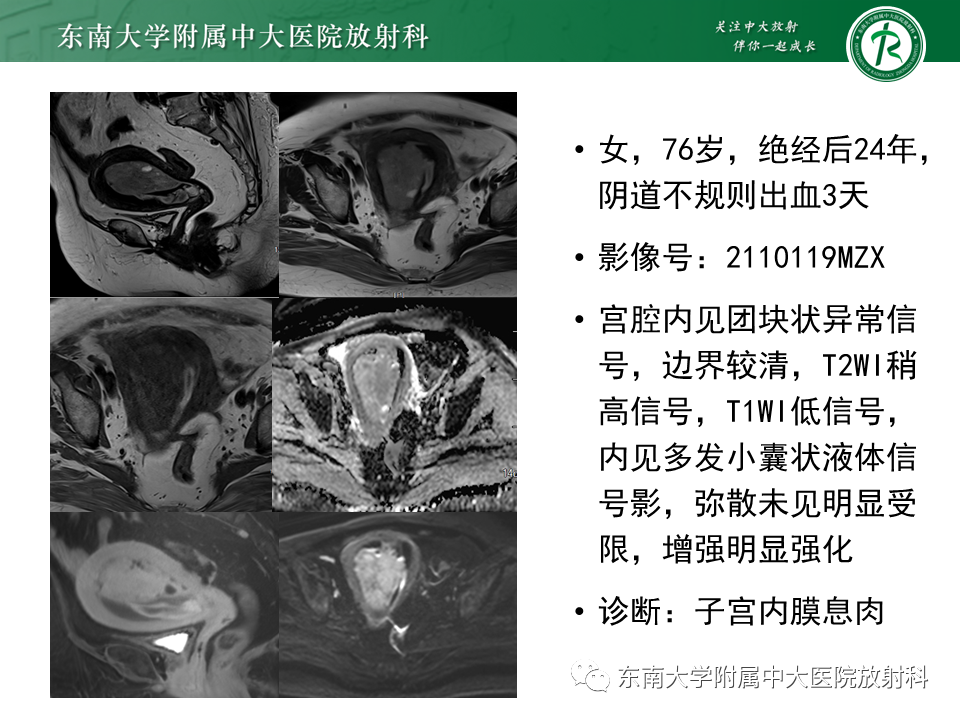 影像PPT - 【PPT】子宫内膜癌MRI诊断-31 影像PPT - 【PPT】子宫内膜癌MRI诊断-31