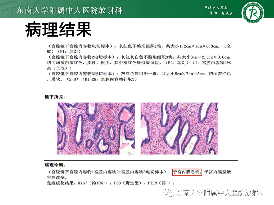 影像PPT - 【PPT】子宫内膜癌MRI诊断-32 影像PPT - 【PPT】子宫内膜癌MRI诊断-32
