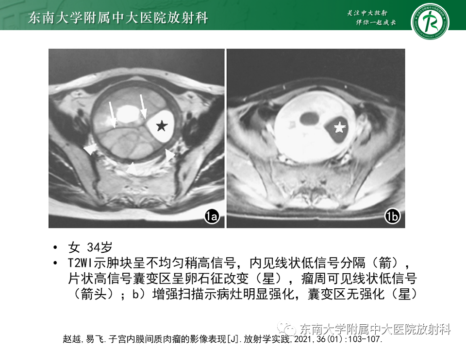 影像PPT - 【PPT】子宫内膜癌MRI诊断-35 影像PPT - 【PPT】子宫内膜癌MRI诊断-35