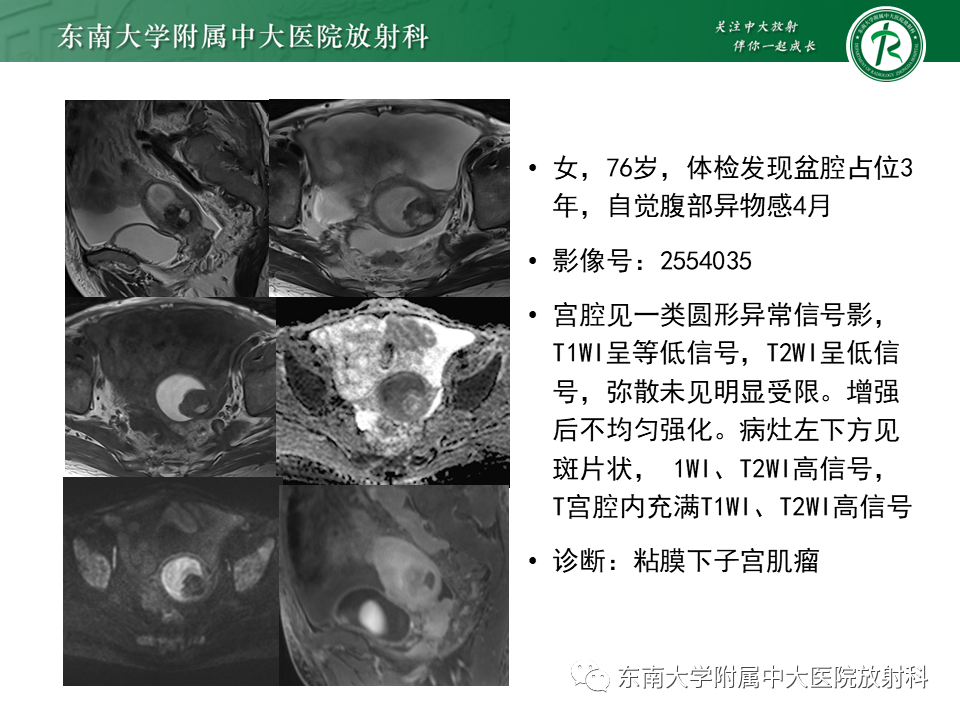 影像PPT - 【PPT】子宫内膜癌MRI诊断-38 影像PPT - 【PPT】子宫内膜癌MRI诊断-38