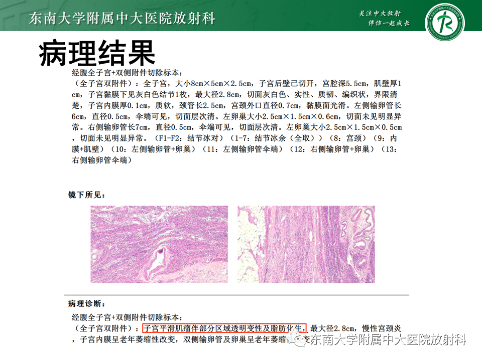 影像PPT - 【PPT】子宫内膜癌MRI诊断-39 影像PPT - 【PPT】子宫内膜癌MRI诊断-39