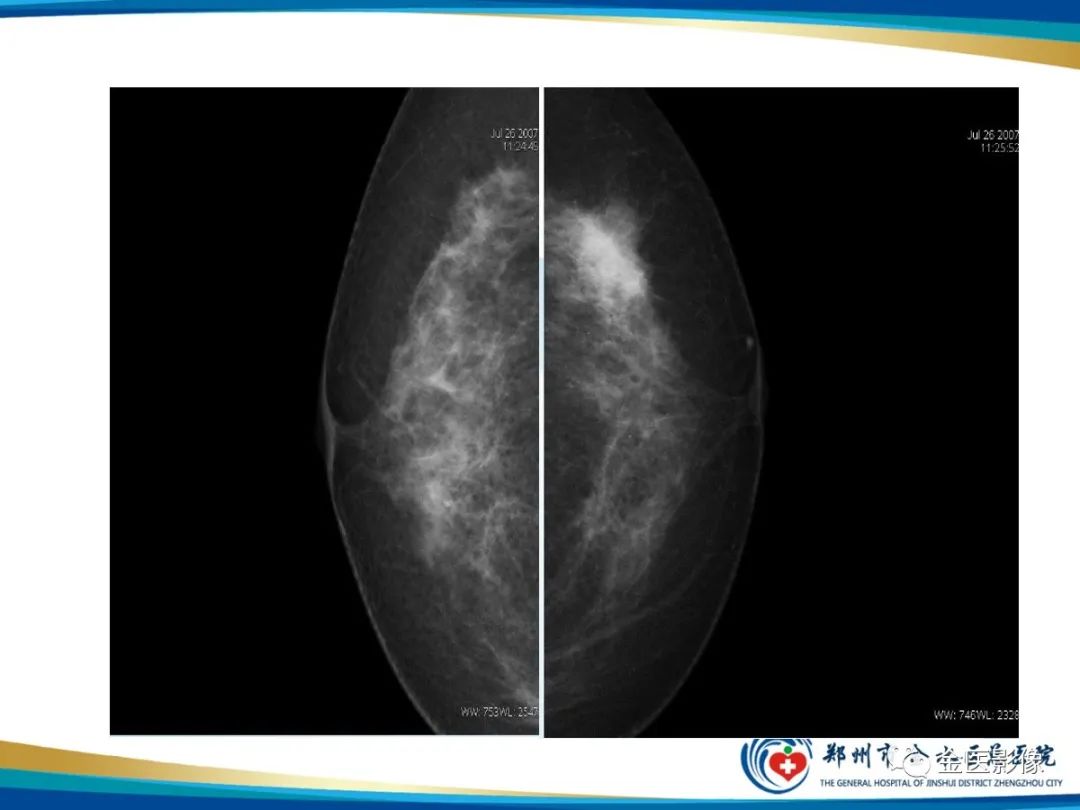 影像PPT - 【PPT】乳腺数字化钼靶X线诊断及临床应用-10