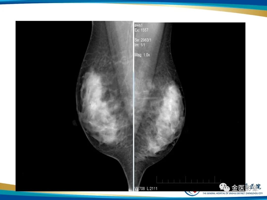 影像PPT - 【PPT】乳腺数字化钼靶X线诊断及临床应用-11