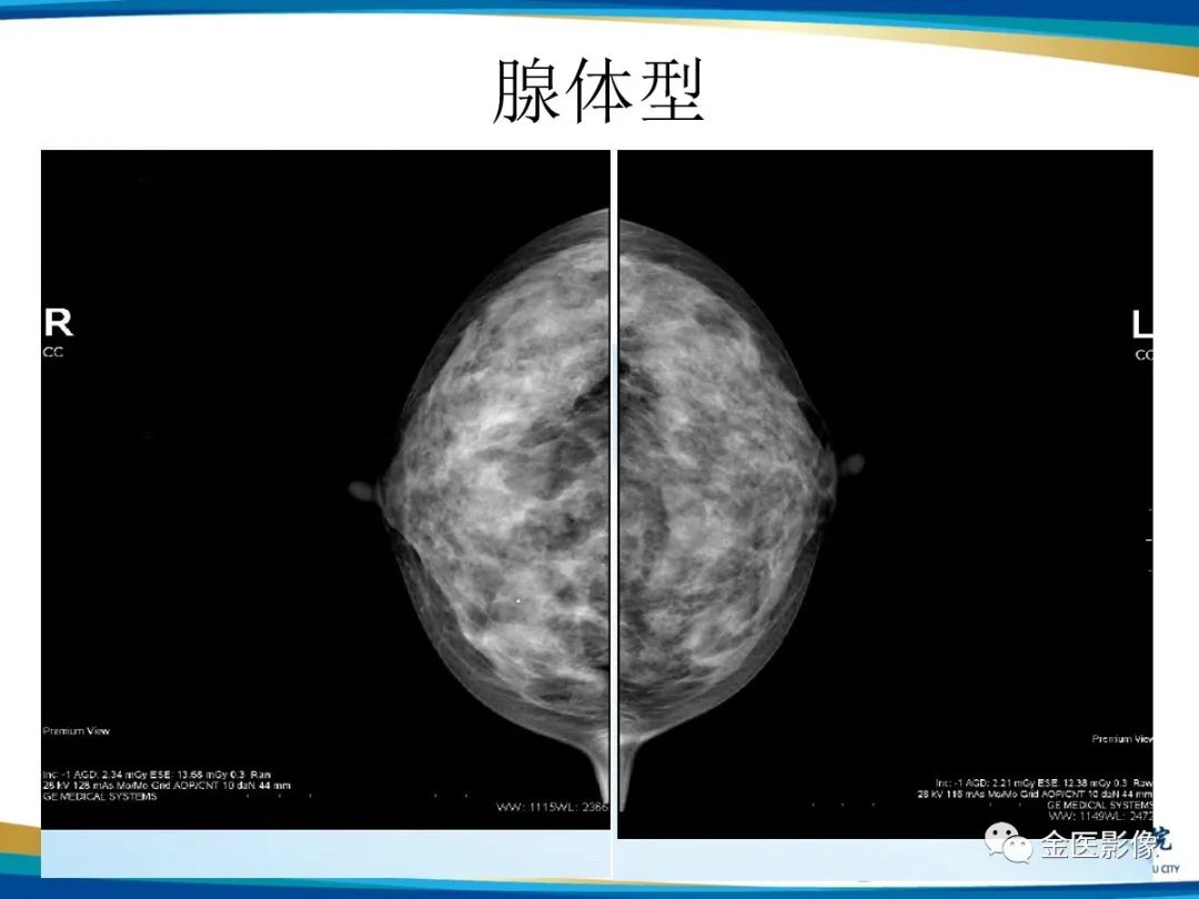 影像PPT - 【PPT】乳腺数字化钼靶X线诊断及临床应用-15