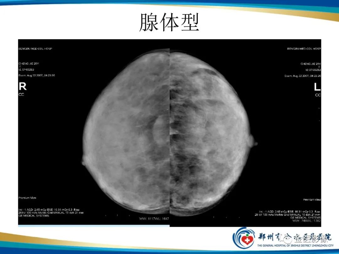 影像PPT - 【PPT】乳腺数字化钼靶X线诊断及临床应用-16