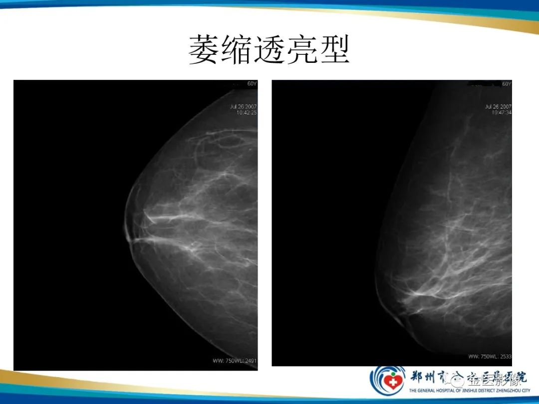 影像PPT - 【PPT】乳腺数字化钼靶X线诊断及临床应用-17