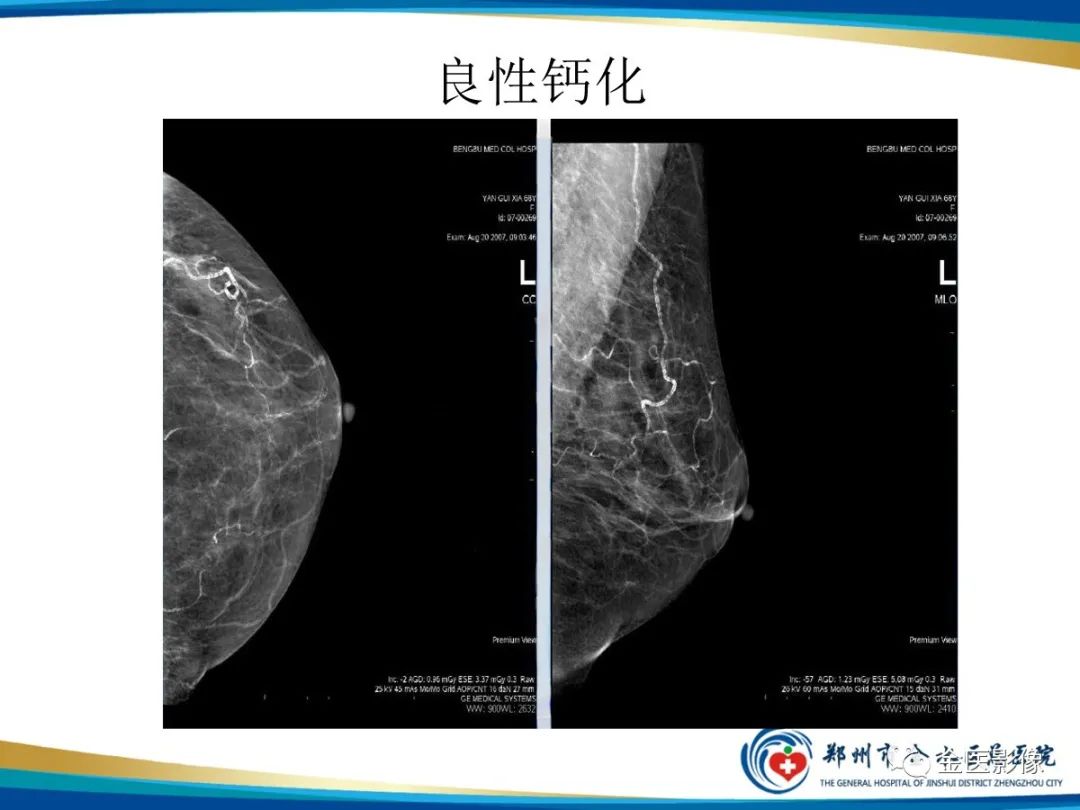 影像PPT - 【PPT】乳腺数字化钼靶X线诊断及临床应用-18