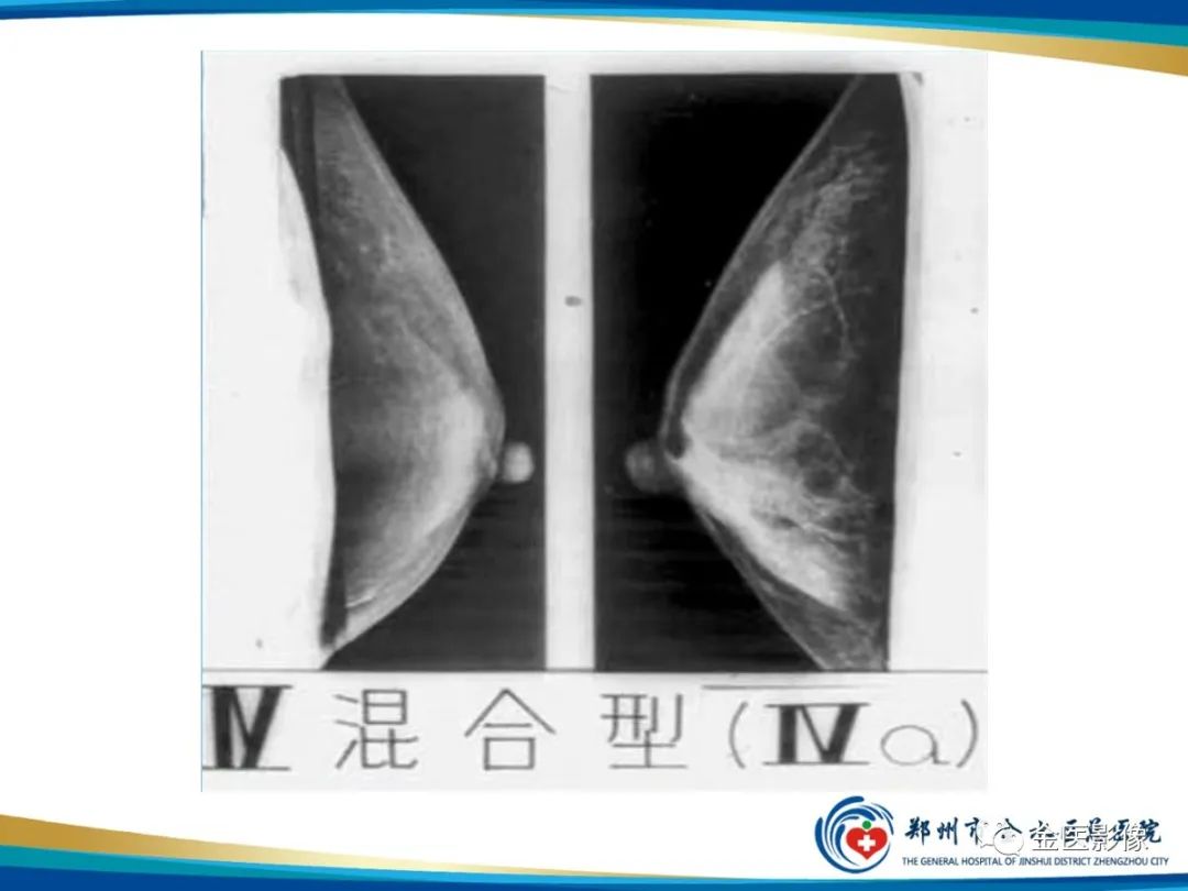 影像PPT - 【PPT】乳腺数字化钼靶X线诊断及临床应用-19