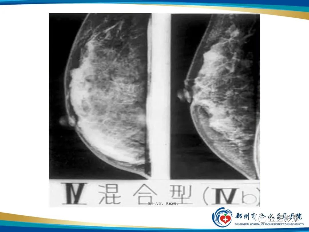 影像PPT - 【PPT】乳腺数字化钼靶X线诊断及临床应用-20