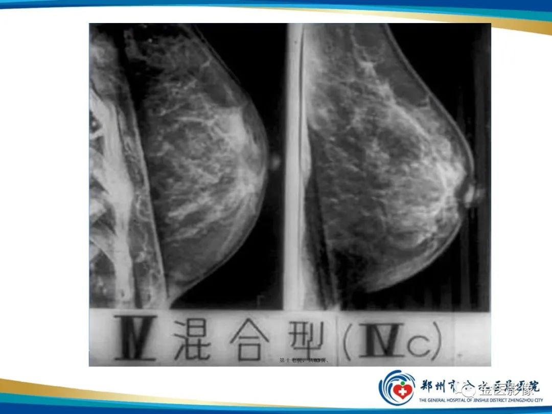 影像PPT - 【PPT】乳腺数字化钼靶X线诊断及临床应用-21