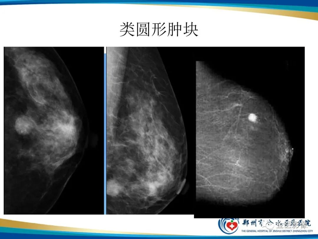 影像PPT - 【PPT】乳腺数字化钼靶X线诊断及临床应用-23